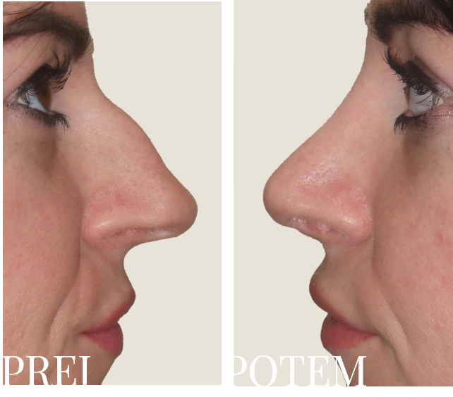 Estetika Nobilis prej in potem rinoplastika, leva stran je slika kako je oseba izgledala prej, na desni strani pa je kako izgleda po posegu rinolatike