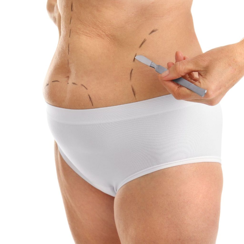 liposukcija korekcija trebuha nobilis
