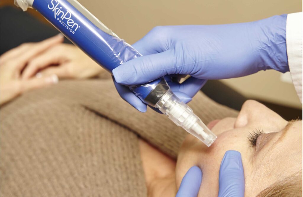 Microneedling Estetika Nobilis, prikaz uporabe SkinPen-a za microneedling obraza